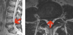 MR Bilder: Pfeile zeigen auf einen Bandscheibenvorfall